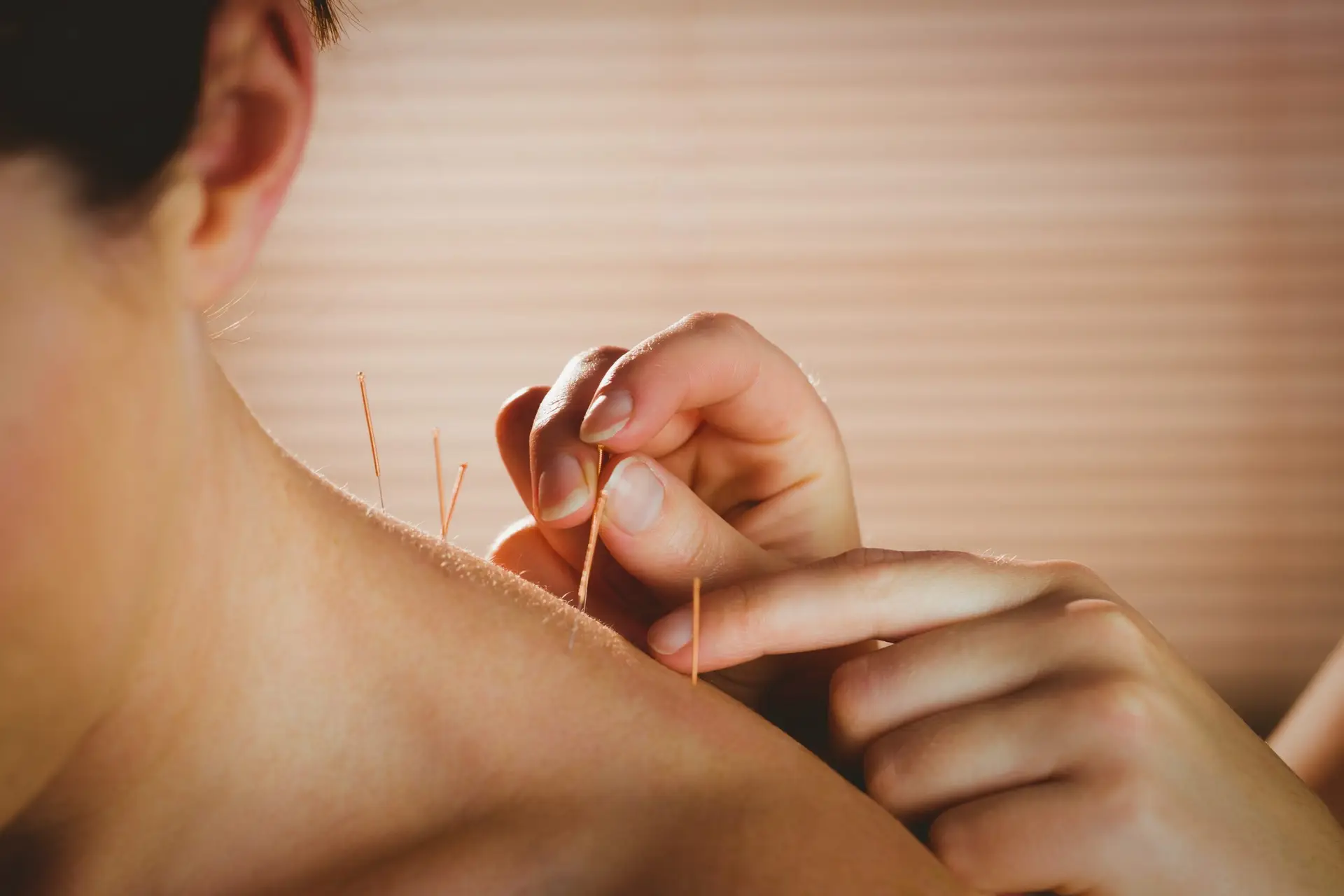 Dry Needling Vs. Acupuncture: Differences and Benefits AdobeStock 89033970 scaled 1 Dry Needling Vs. Acupuncture: Differences and Benefits